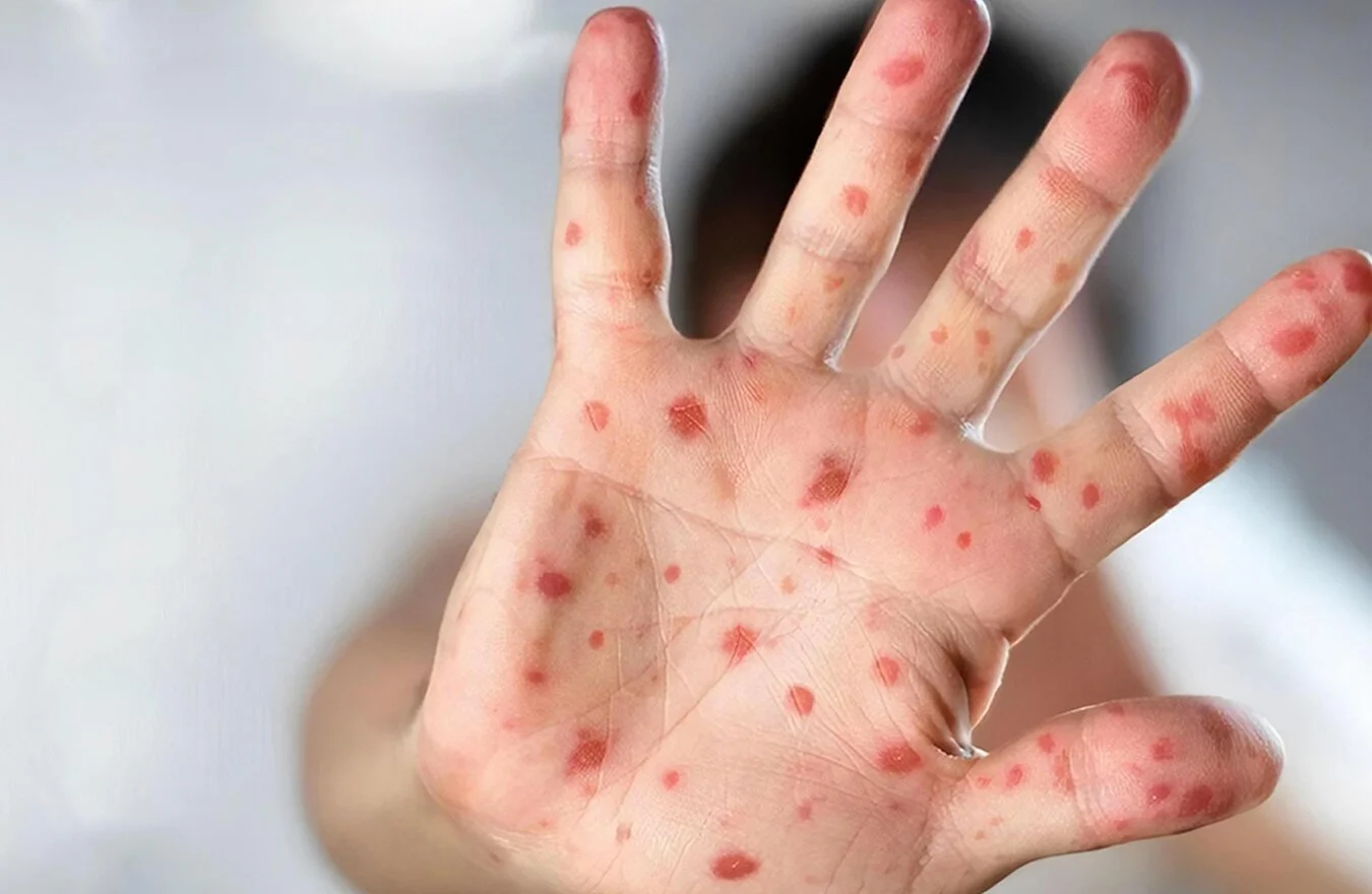 В Україні зафіксували спалах вірусу Коксакі серед дітей