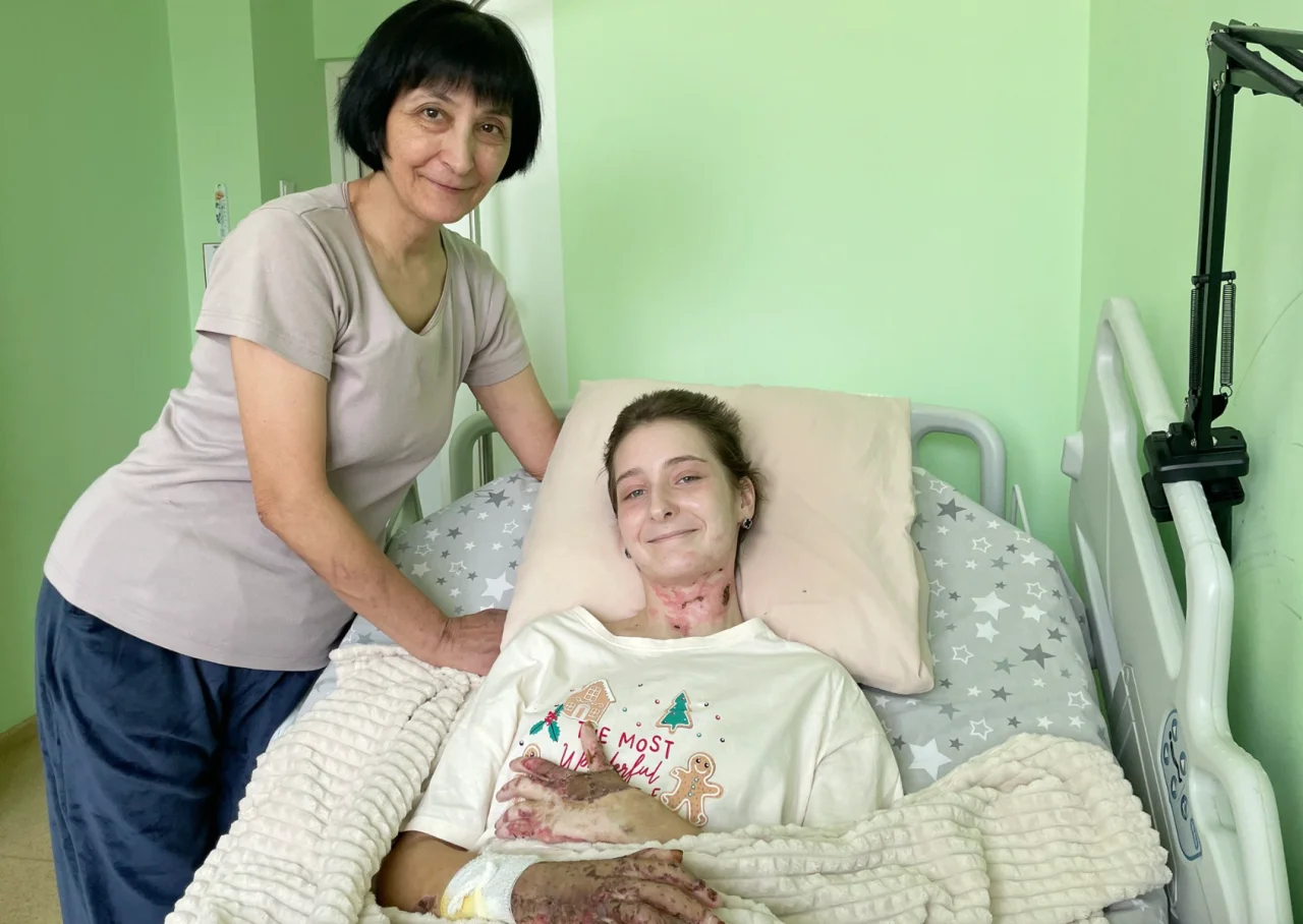 14-річна Настя, яка отримала сильні опіки через атаку росіян, зробила перші кроки