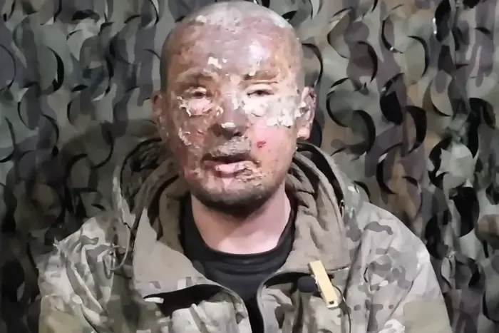 Обгорілого окупанта вилікували в полоні