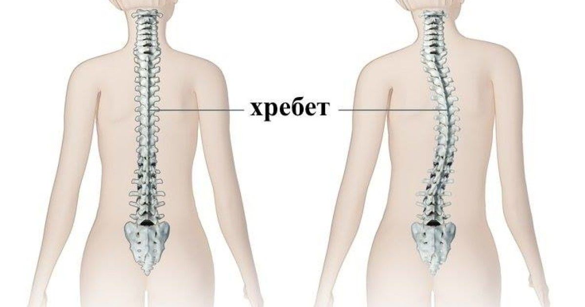 Левосторонний сколиоз. Деформация позвоночника. S образный сколиоз.