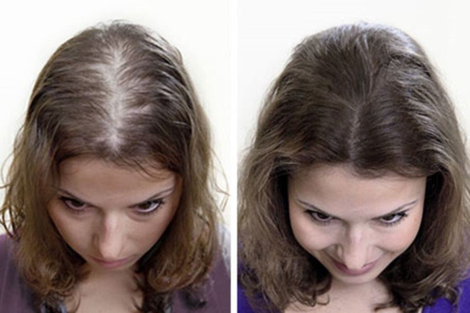 Кормящих выпадают волосы. Андрогенная алопеция Гамильтон. Редкие волосы у женщин. Алопеция у женщин до и после.