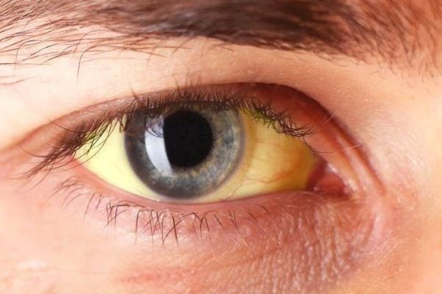 Описание желтых глаз. Синдром Жильбера склеры. Пожелтение склер гепатит. Механическая желтуха склер. Желтушность склер при гепатите.