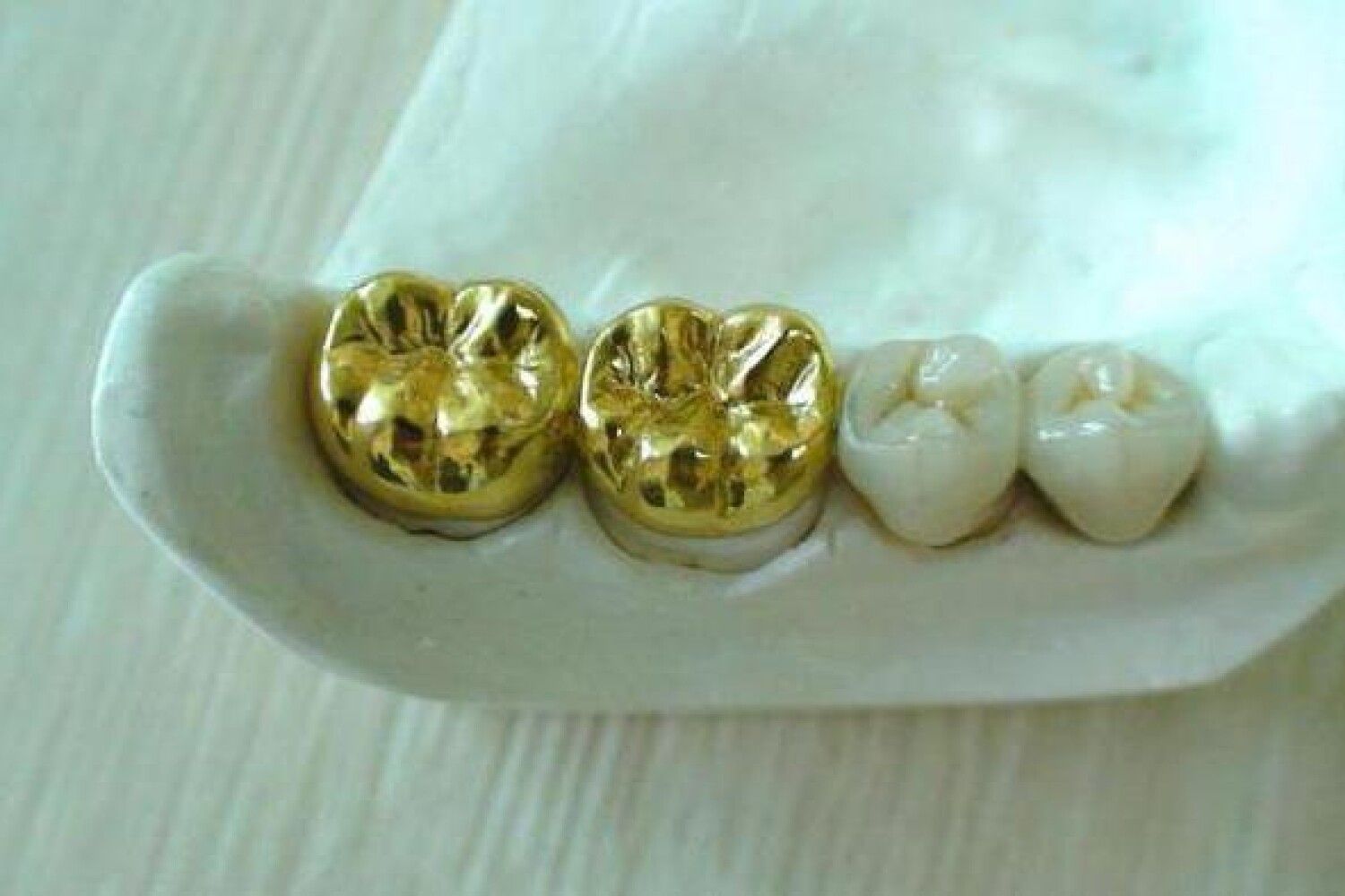 что такое мосты на зубы с напылением