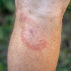 На Волині кліщі прокинулися раніше і вже атакують людей у парках та лісах (Відео)