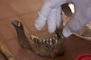 Вчені виростили зі свинячого жиру кістку щелепи