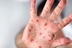 Волинь – серед лідерів за ураженням кором