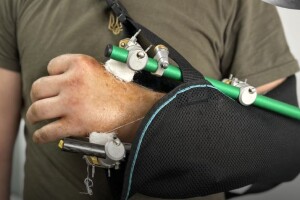 Лікарі пришили пацієнту руку,  яку він відрізав собі бензопилою!