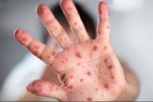 В Одесі від ускладнень кору померла однорічна дитина