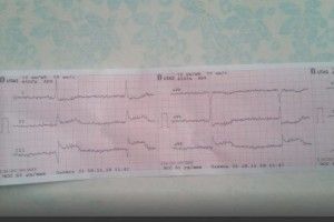 Бабусю з інфарктом рятували дві бригади «швидкої»
