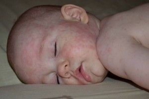 У Ратнівському районі шириться кір