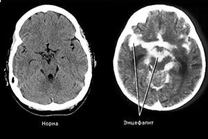 Малюк у комі – медики прогавили у дитини енцефаліт