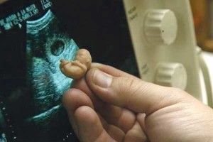 Аборт не можна забороняти хоча б тому, щоб від багатьох політиків подібні не народжувались…