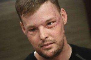 Лікарі пересадили чоловіку ніс, щоки, рот, губи, щелепу, підборіддя і зуби (Вражаючі фото і відео)