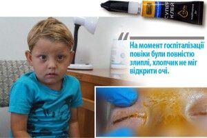Трирічний хлопчик заклеїв собі очі суперклеєм