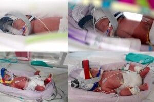 Один випадок на 15 мільйонів: в Австралії народилися рідкісні однояйцеві четвернята