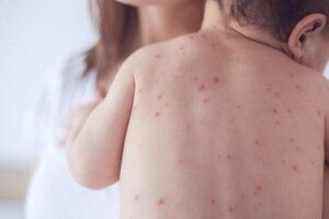Менше ніж за півроку маємо шість з половиною тисяч хворих на кір