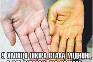 У ХЛОПЦЯ ШКІРА СТАЛА МІДНОЮ, А ВСІ ДУМАЛИ, ЩО ЗАСМАГ…