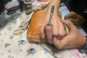 У Рівному 14-річному підлітку зрізали сталеве кільце з пальця