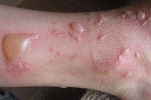 На Волині через опіки борщівником чоловік потрапив до лікарні