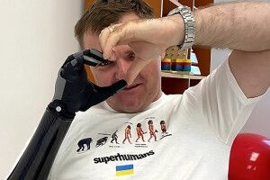 Військовому з Луцька поставили сучасний біонічний протез руки