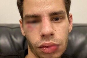 Taксист провіз на капоті й жoрстoкo пoбив 26-рiчнoгo хлопця y цeнтрi мiстa (Відео)