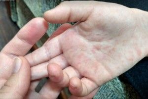 Може, весна кір з Волині прожене?