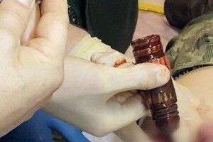 Медики дістали з тіла пораненого воїна бойову частину гранати (Фото)