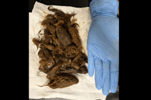 Волинські хірурги витягли 700-грамовий клубок волосся з шлунка 7-річної дівчинки