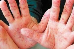 Львівщину рятують від кору