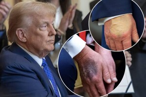 Дональду Трампу – 80: які хвороби приписували президенту США