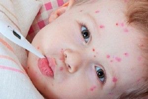 Волиняни продовжують хворіти кором