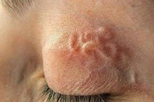 У Рівному зафіксовано ще один випадок підшкірного дирофіляріозу