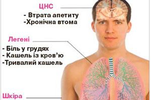  У 653 ВОЛИНЯН ТОРІК ВИЯВЛЕНО ТУБЕРКУЛЬОЗ 
