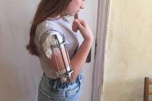 Завдяки лікарям, 6-річна дівчинка житиме повноцінним життям