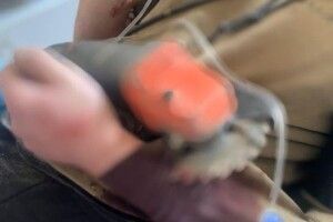 До Нововолинської лікарні доставили чоловіка з електропилою в передпліччі