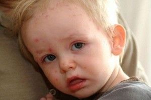 За одну добу в області зареєстровано 15 нових випадків кору