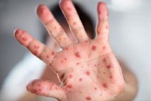  Кір на Любешівщині виявили у матерів і їхніх діток