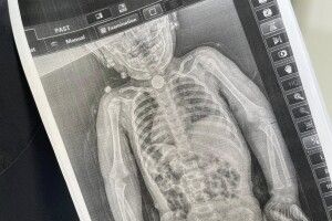 У Львові прооперували 2-річну дівчинку, яка три місяці прожила з батарейкою у стравоході