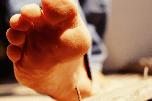 Після шестирічної перерви на Волині зареєстровано випадок захворювання на правець