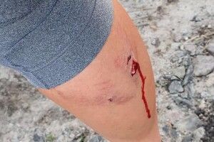На Волині тренерку під час пробіжки покусав собака