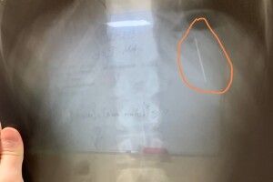 13-річний хлопець випадково проковтнув голку (Фото)