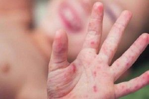 Сумний рекорд: кір на Волині став поширюватись удвічі швидше 