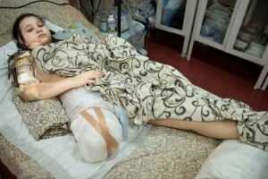 15-річну дівчинку, яка втратила ногу через обстріл мирного міста, евакуювали у Німеччину