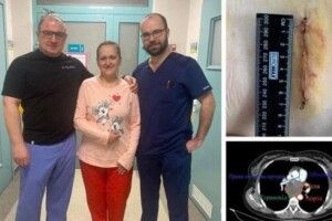 Не могла ковтати їжу: у Рівному прооперували жінку з великою кістою