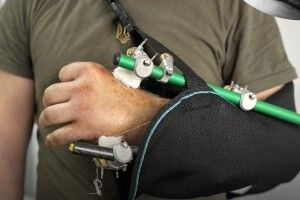 Ювелірна робота: у Львові лікарі врятували пацієнту відрізану кінцівку