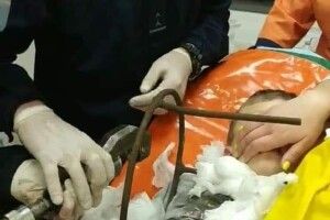 5-річний хлопчик грався у дворі та проштрикнув собі шию штирем 