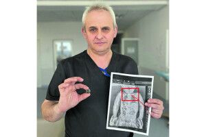 2-річна Софійка місяцями жила  з батарейкою у стравоході