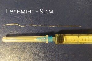 У волинянки з ока витягнули 9-сантиметрового глиста