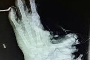 На Волині петарда важко травмувала хлопчика