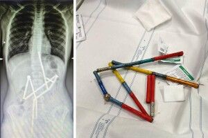 Небезпечні іграшки: у Києві лікарі врятували хлопчика, який проковтнув 20 магнітів